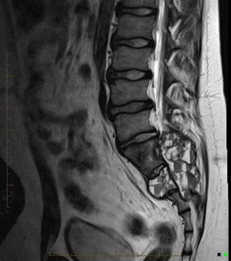 Aneurysmal Bone Cyst Sacrum Radiology Case