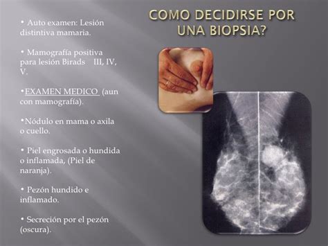 Cancer De Seno Prevencion Y Tratamiento