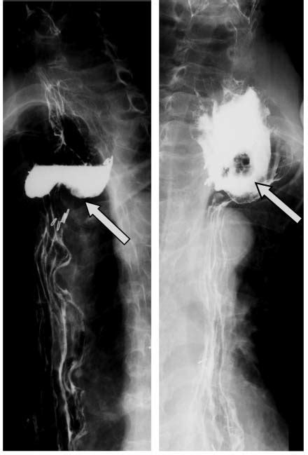 A Large Oval Mass Protrudes From The Left Side Of The Neck Figure 2