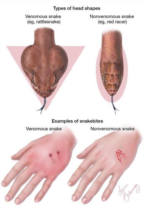 Maybe you would like to learn more about one of these? Snake bite treatment - PestWiki