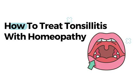 How To Treat Tonsillitis With Homeopathy
