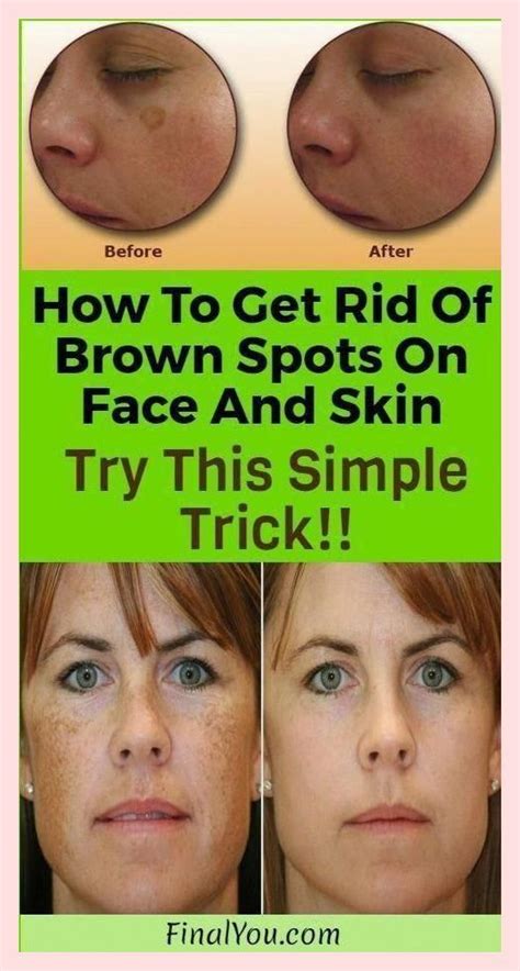 Simple Trick To Remove Brown Spots From Your Skin In 2022 Brown Spots On Face Spots On Face