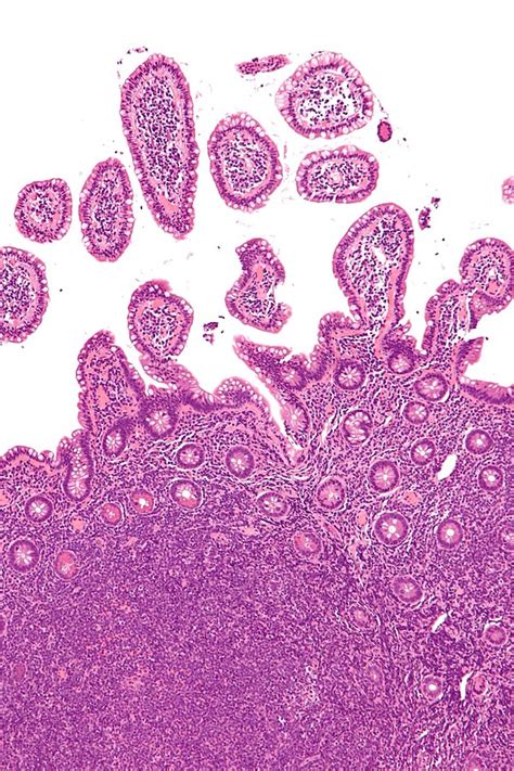 Mantle Cell Lymphoma Libre Pathology