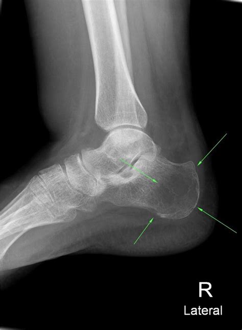 X Ray Of The Right Ankle Well Marginated Lytic Lesion In The Posterior
