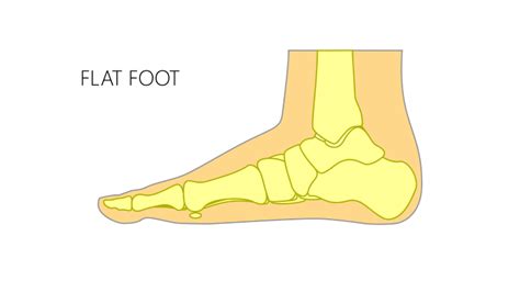 Examine The Causes Of Flat Feet And The Best Way To Treat It Dr