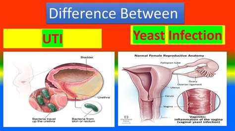 Difference Between Uti And Yeast Infections Youtube