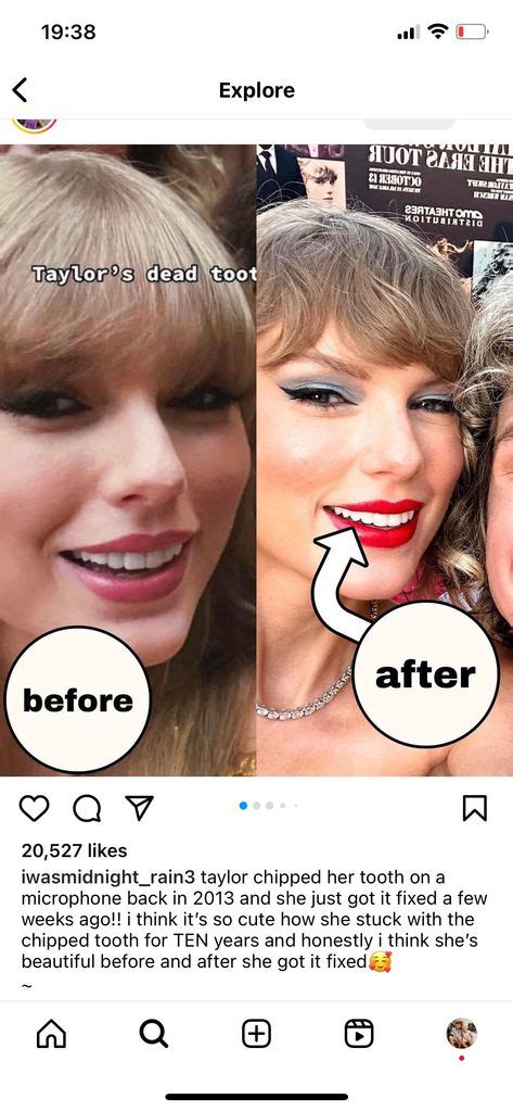 Taylor Swifts Teeth Transformation In Before And After Photos Spark