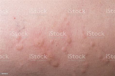 Hives Stock Photo Download Image Now Hives Skin Condition Skin