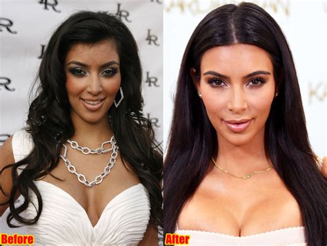 Kim Kardashian Face Surgery Before And After Photos