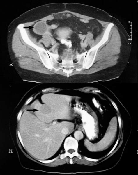 Peritoneal Carcinomatosis From A Small Bowel Carcinoid Tumour World