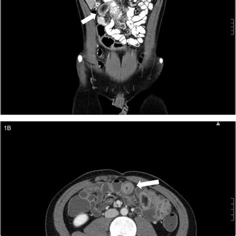 A Computed Tomography Ct Scan Of The Abdomen And Pelvis Depicting