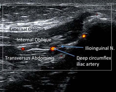 A Simplified Approach To Ultrasound Guided Ilioinguinal Nerve Block