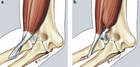 Distal Biceps Short Head Tears Repair Reconstruction And Systematic