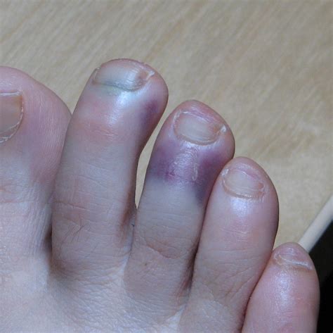Infected Toe