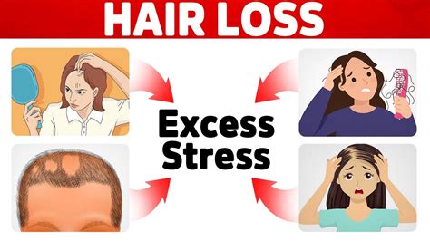 The Hidden Cause Of Your Hair Loss Different Types Youtube