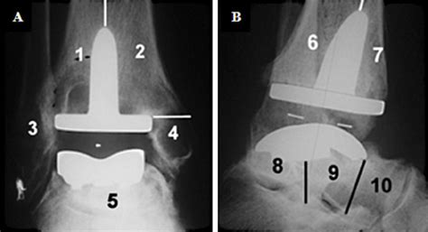 Plain X Ray Peri Prosthetic Osteolysis Assessment Protocol For Aes Tar