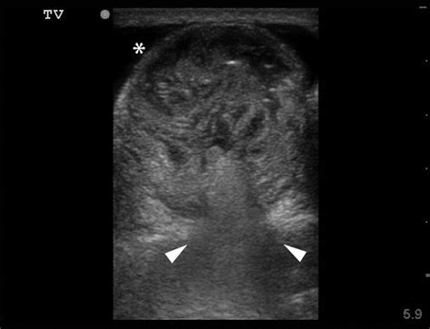 Diagnosis And Reduction Of A Hernia By Bedside Ultrasound A Case