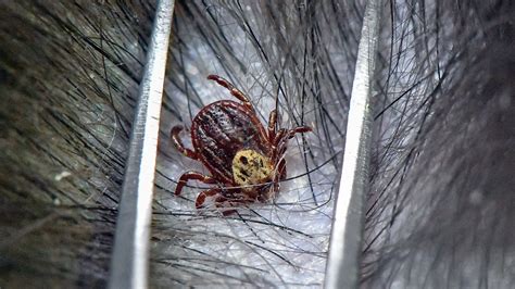 Tick Bites Leave 5 Year Old Girl Hospitalized Unable To Swallow Or