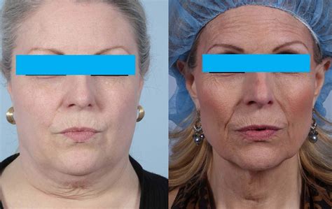 Why Does Weight Loss Make Your Face Look Older Dr Brett Kotlus