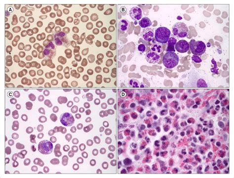 Peripheral Blood Pb Smear And Bone Marrow Bm Aspirate Findings Of