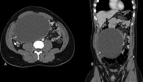 Axial And Coronal Contrast Ct Abdomen And Pelvis Showed A Large