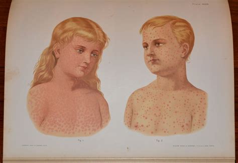 Atlas Of Skin And Venereal Diseases Par Morrow Prince Albert 1846