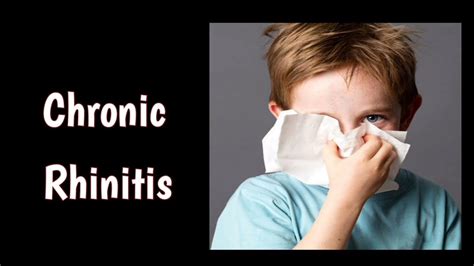 Chronic Simple Rhinitis Chronic Rhinitis 1 Youtube