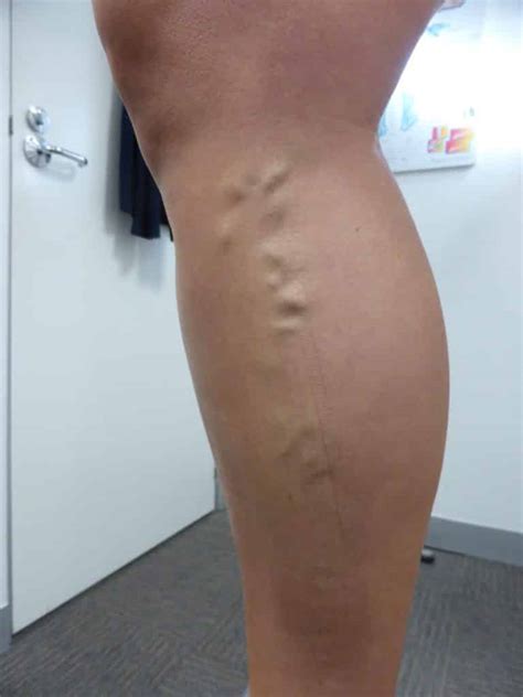 Varicose Vein Treatment Melbourne Collins Cosmetic Clinic