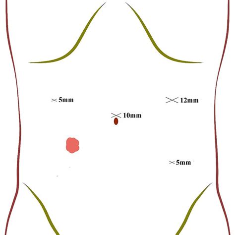 Trocar Position And The Size Of Trocars Download Scientific Diagram