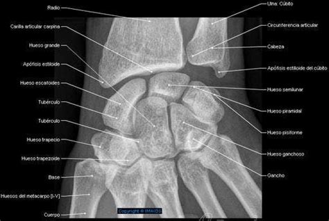 Atlas De Anatomía Radiography Carpo Hueso Escafoides Tubérculo
