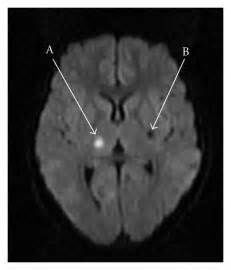Diffusion Weighted Imaging Dwi Mri Of The Brain Showing An Acute Svi