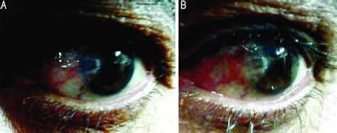 Decrease In The Vascularity Of The Pterygium Before And After Single