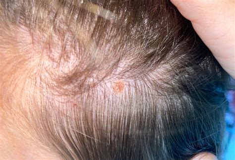 Early Stage Melanoma On Scalp Pictures Symptoms And Pictures