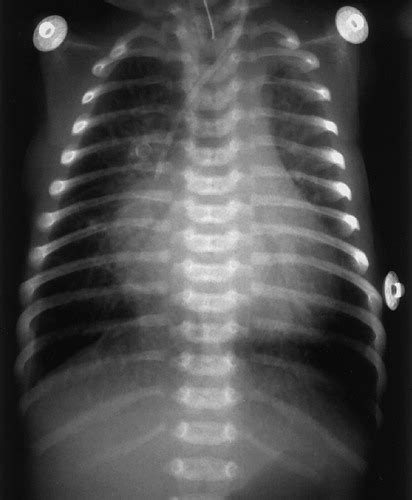 Pediatric Ribs A Spectrum Of Abnormalities Radiographics