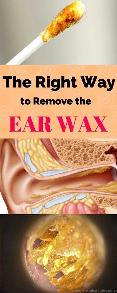Pin By Patricia Mckinlay On Health Tips Ear Wax Ear Cleaning Wax