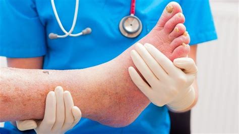 Global Chemotherapy Induced Acral Erythema Hand Foot Syndrome