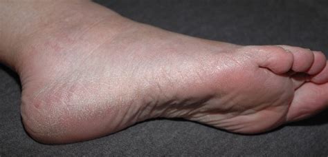 Itchy Feet Causes And Cures Part 2 Podiatry Hq