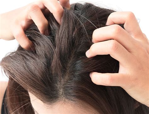 Dry And Itchy Scalp Causes And Cure