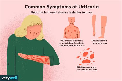 Enfermedad de la tiroides y ronchas crónicas urticaria Medicina Básica