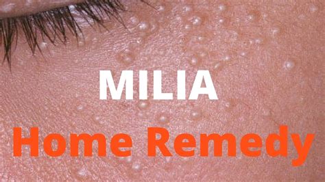 What Causes Milia And What Treatments Are There