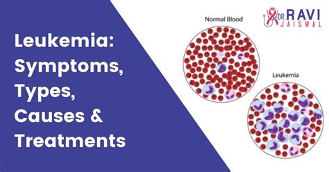 Leukemia Symptoms Types Causes And Treatments