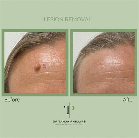 Your Ultimate Guide To Common Benign Skin Lesions Skinfluencer