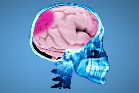 Concussions And Post Concussion Syndrome Rehmeyer And Allatt