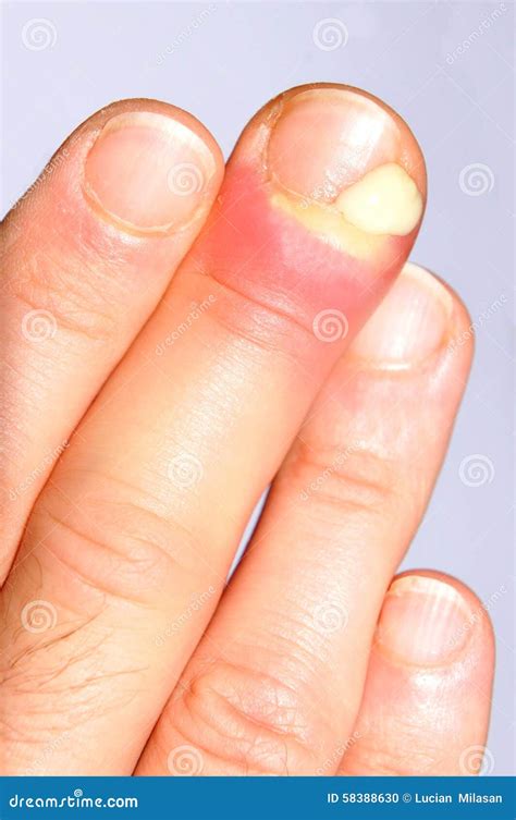 Infected Finger Swollen Hand Stock Photos Free And Royalty Free Stock