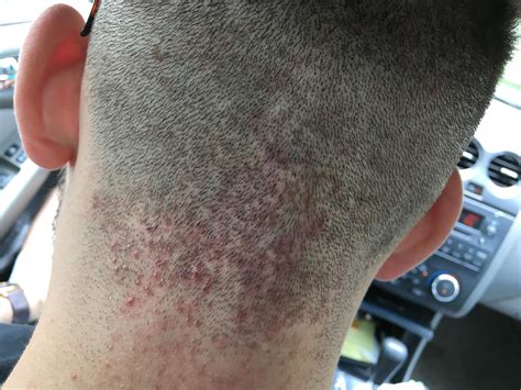 Red Bumps On Neck