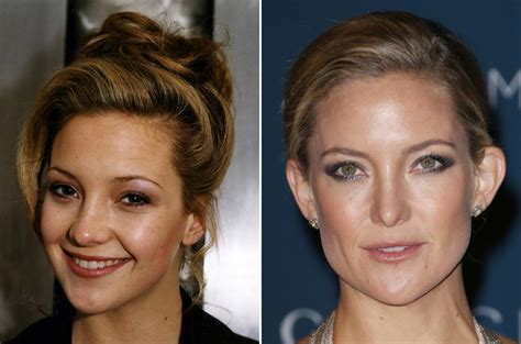 Kate Hudson Plastic Surgery Before And After Photos Celeblens Hot Sex Picture