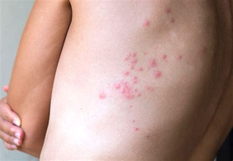 Pictures Of A Bed Bug Rash Pest Phobia