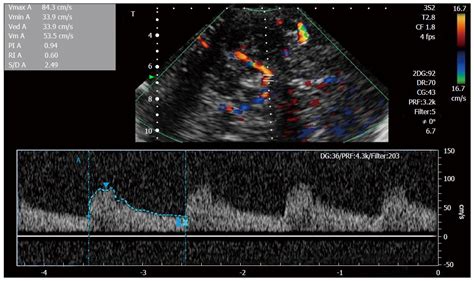 Transcranial Doppler Ultrasonography From Methodology To Major