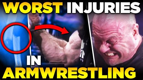Top 3 Worst Armwrestling Injuries And How To Prevent Them Youtube
