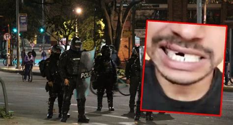 Denuncia De Abuso Policial Joven Dice Que Le Tumbaron Dientes